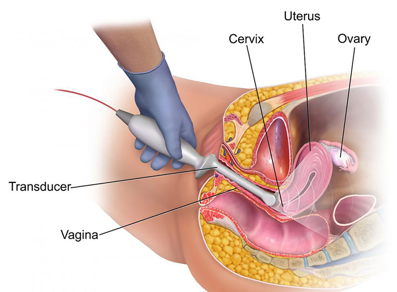 Hizmetler - Vaginal Ultrasonography